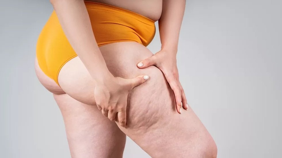 Kilo veremiyorsanız suçlu iradeniz değil, lipödem olabilir